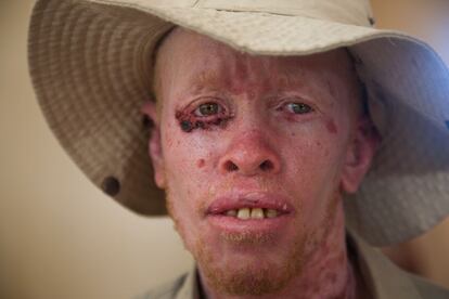 Tanzania tiene una carencia crónica de especialistas y recursos para tratar las cuestiones asociadas al albinismo y al cáncer. En un país con más de 40 millones de habitantes, solamente existe un centro con servicios oncológicos. En la foto, un hombre albino con quemaduras en la cara.