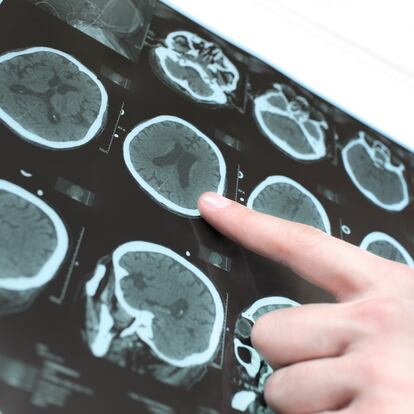 CT scan of the patient's brain and the hand of a doctor. Photo.