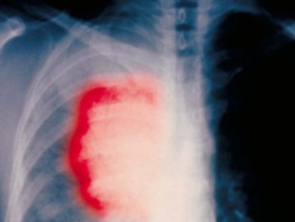 Radiografía de un fumador con cáncer de pulmón.