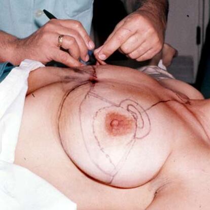 Preparación del pecho de una mujer para colocarle un implante mamario de silicona.