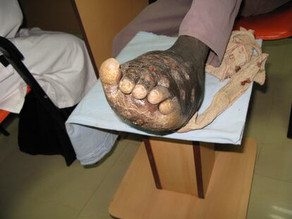 Paciente sudanés con micetoma, una enfermedad tropical desatendida de la piel, causada por un hongo, que empieza por una pequeña úlcera que crece progresivamente y va consumiendo los tejidos, los músculos y los huesos.