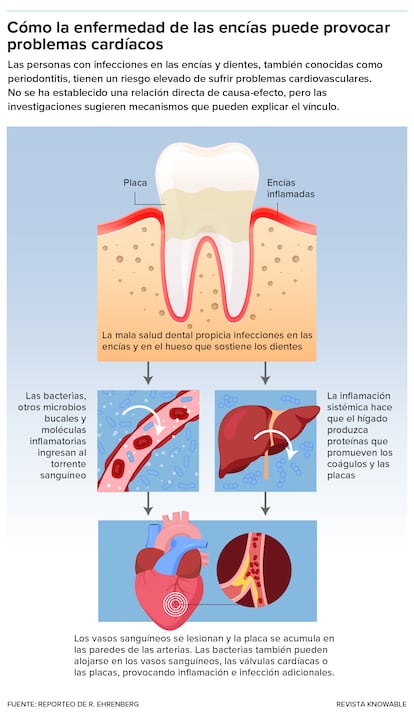 Las investigaciones que exploran el vínculo entre la enfermedad de las encías y los problemas cardiovasculares sugieren que la inflamación crónica y las bacterias orales juegan un rol en dicha relación.