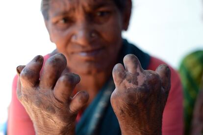 Gowreamma muestra lo que queda de sus manos. "No sabíamos qué nos pasaba, ni si existía tratamiento para ello. Creíamos que era un castigo divino", dice.