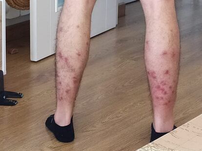 Las piernas de Pablo López tras el ataque de las moscas negras.