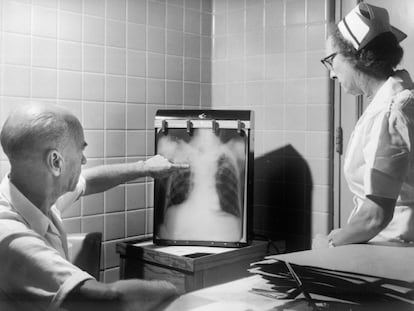 Un médico y una enfermera examinan una radiografía de tórax positiva para tuberculosis en el año 1958.