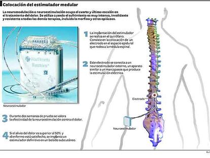 Electrodos para el dolor intratable