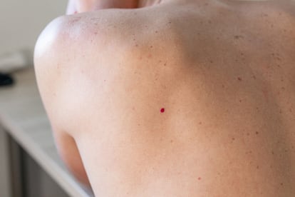 Foto de archivo de una espalda con puntos rubí, también conocidos en inglés como "cherry angyoma".