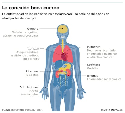 Las dolencias dentales, incluida la enfermedad de las encías, se han relacionado con numerosos problemas de salud en otras partes del cuerpo.