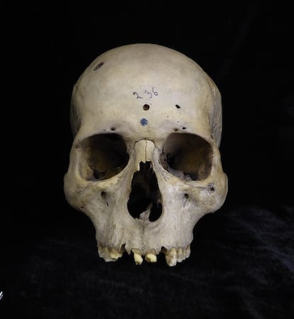 Male skull with circular cancerous lesions.