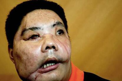 Li Guoxing fue sometido a un transplante parcial de rostro tras ser desfigurado por un oso