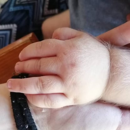 La mano de un bebé afectado por el síndrome del hombre lobo.