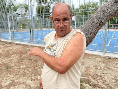 Paolo Barin enseña las cicatrices de las picaduras de las chinches. Hasta el jueves se alojaba en el Hostal Casa Sofía, en Tetuán.