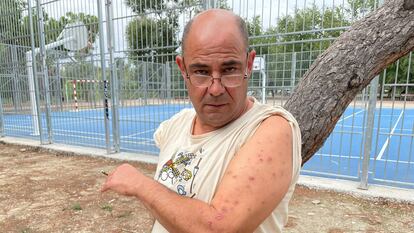 Paolo Barin enseña las cicatrices de las picaduras de las chinches. Hasta el jueves se alojaba en el Hostal Casa Sofía, en Tetuán.