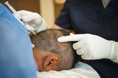 Implantes de pelo Turquia