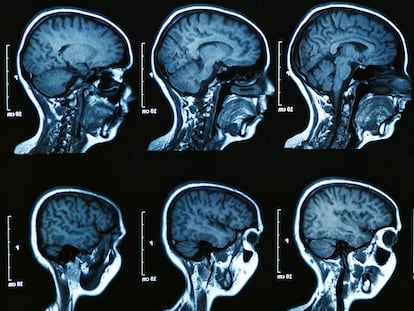 Resonancia magnética de un cerebro humano.