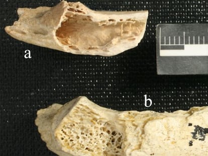 Microescáner del fragmento de costilla neandertal de hace 120.000 años, del yacimiento de Krapina (Croacia), en el que se aprecia el deterioro dentro del hueso por un tumor benigno.