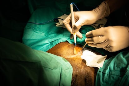 Giménez Bachs, urólogo en el Complejo Hospitalario Universitario de Albacete, sostiene que “la cirugía son pasos reglados”. “Luego hay que tener recursos por si surgen complicaciones”, añade. En el caso de la adenomectomía (extirpar el tumor benigno que crece en la próstata), los cirujanos abren primero las diferentes capas de la piel. “Al final, lo que se busca es aumentar la calidad de vida del paciente. El adenoma obstruye el cuello de la vejiga e impide hacer pis total o parcialmente”, explica el manchego.