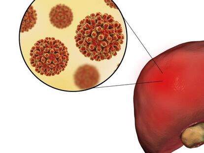 La hepatitis C, más cerca de erradicarse