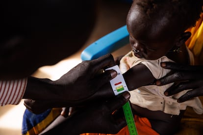 Examen médico de una niña en búsqueda de síntomas de desnutrición, en el asentamiento de refugiados de Rotriak (Sudán del Sur)