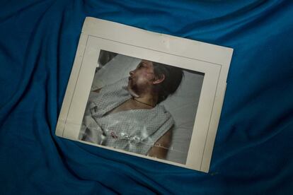 Belén Torres, de 20 años. Esta foto de ella fue realizada después de ser atacada por El Anestesista.
