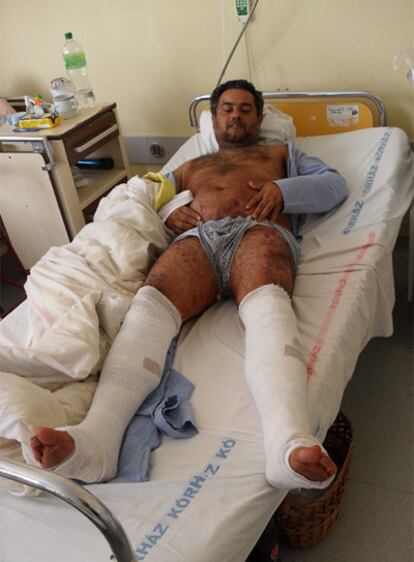 Karoly, de 38, muestra las heridas que le ha causado el barro rojo en el Hospital Provincial de Vezprém.