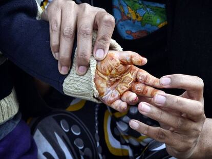 Una mujer muestra la mano quemada de su hijo en el campo de Hellinikon, en Grecia, el pasado seis de febrero, durante una protesta de los refugiados en &eacute;l por las malas condiciones del asentamiento.