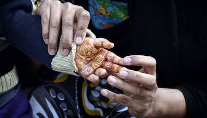 Una mujer muestra la mano quemada de su hijo en el campo de Hellinikon, en Grecia, el pasado seis de febrero, durante una protesta de los refugiados en &eacute;l por las malas condiciones del asentamiento.