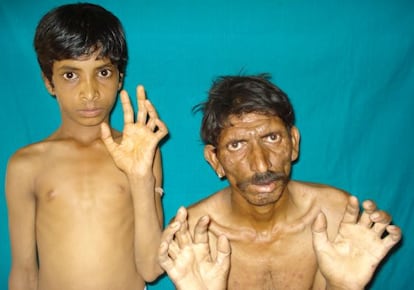 Revaram y su hijo de 10 años Prakash muestran sus manos deformadas por la lepra.