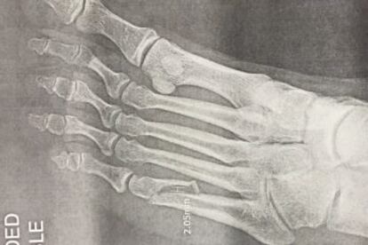La radiografía donde se ve la fractura del dedo (izquierda) del pie de Axl Rose.