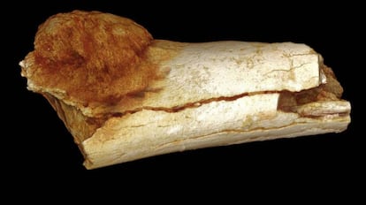 La representaci&oacute;n volum&eacute;trica de una imagen de la morfolog&iacute;a externa del hueso del pie muestra el grado de expansi&oacute;n del c&aacute;ncer &oacute;seo primario m&aacute;s all&aacute; de la superficie del hueso. 