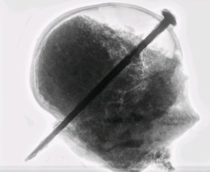 Radiografía de unos los cráneos enclavados.