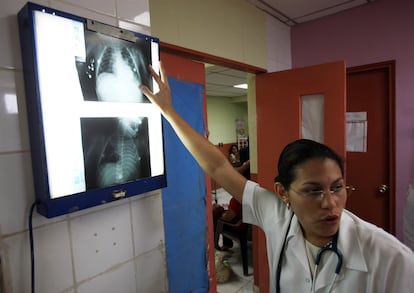 Una doctora examina una radiografía que muestra los pulmones devastados por la neumonía de Steven Fernando Castellón, de ocho meses, en el hospital Infantil Manuel de Jesús Rivera en Managua (Nicaragua). Steven comenzó a tener convulsiones, tos y fiebre 10 días antes de llegar al hospital desde su remota casa en La Dalia, cerca de Matagalpa, en el norte del país.