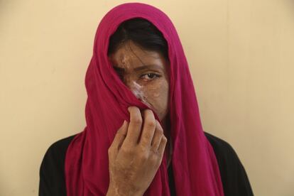 Sana Naz, superviviente de un ataque por ácido en un acto organizado por una ONG con motivo del Día Internacional de la Mujer, en Karachi (Pakistán)
