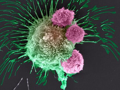 Vista al microscopio de una célula de cáncer de mama atacada por tres linfocitos del sistema inmune.