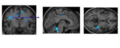 Cerebro de una persona mayor de 65 años sana. En azul, las regiones que se activan durante la labor de memorización visual. Las personas sanas con mayores reservas cognitivas activan menos regiones porque necesitan menos recursos.
Por el contrario, las personas mayores con alzhéimer o algún tipo de deterioro cognitivo que han cultivado reservas presentan una mayor activación, ya que pueden compensar las pérdidas físicas ligadas a la enfermedad.