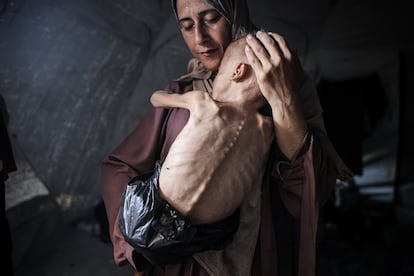 Muhammad Zakariya, de 18 meses, sufre desnutrición severa. Lucha por sobrevivir en una tienda de campaña donde escasean la leche, los alimentos y otros productos básicos en Ciudad de Gaza, el 21 de julio de 2025.
