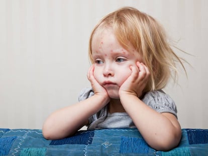 Ni&ntilde;a enferma de sarampi&oacute;n. 