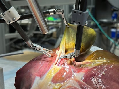 El nuevo sistema, que combina IA generativa y aprendizaje automático, ha realizado con un 100% de precisión algunas de las tareas quirúrgicas necesarias para extirpar vesículas de cerdo