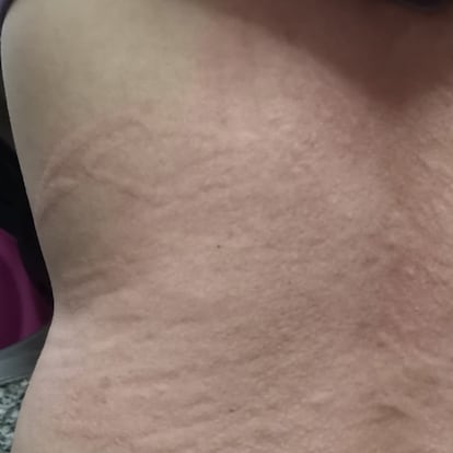 Urticaria asociada al coronavirus.