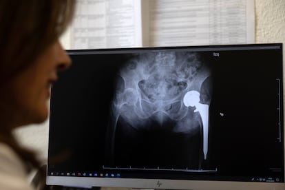 Caídas pacientes principal problema sanitario hospitales en España
