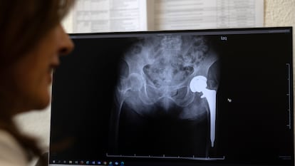 Nuria Montero, geriatra del Hospital Gregorio Marañón, mira la imagen de una prótesis de cadera.