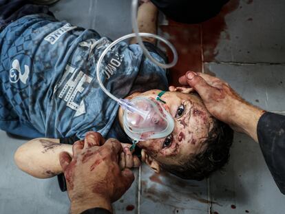 Un niño herido recibe tratamiento en el Hospital de los Mártires de Al-Aqsa tras los ataques del ejército israelí, en Deir Al-Balah, Gaza, este lunes.