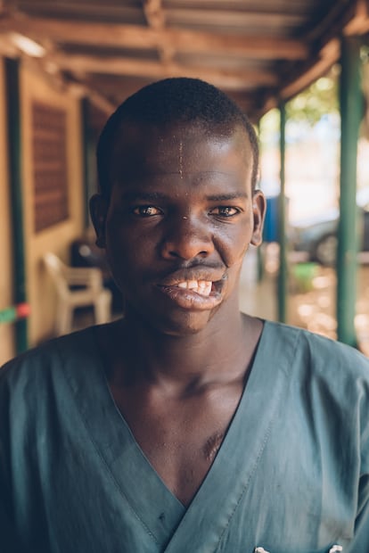 Mohammadu Usman, un superviviente de noma de 22 años, trabaja en el hospital Sokoto Noma, uno de los pocos del mundo especializados en la enfermedad infecciosa. Después de dos rondas de cirugía y un largo tratamiento, su condición mejoró enormemente. Él se siente más seguro: “Ahora puedo ir a cualquier parte y no me siento avergonzado", dice.