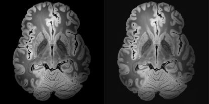 A la izquerda, una imagen de alta resolución de un cerebro. (B. L. Edlow et al, Scientific Data 6:244 (2019)). A la derecha la misma imagen comprimida al 95% con ondículas.
