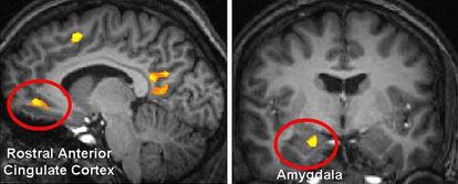 Los círculos muestran la actividad cerebral en personas que están pensando en positivo en el experimento realizado en Nueva York.