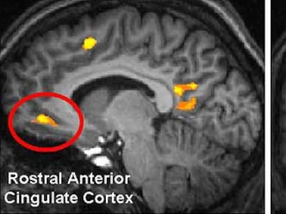 Los círculos muestran la actividad cerebral en personas que están pensando en positivo en el experimento realizado en Nueva York.