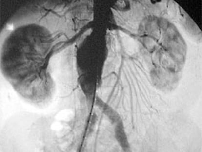 Arteriografía anterior a la intervención que revela el gran tamaño y la proximidad del aneurisma a los riñones.