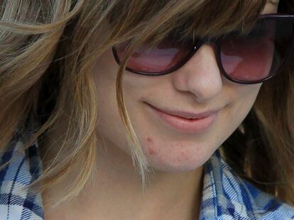 ¿Acné juvenil mucho después de la adolescencia? Sí, es posible