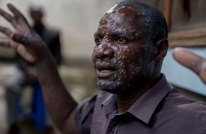 Jean Kakuru Biyambo, de 48 años y residente en el campo de desplazados congolés de Muja, en el hospital de Goma, donde recibía tratamiento contra la mpox, el 16 de julio.
