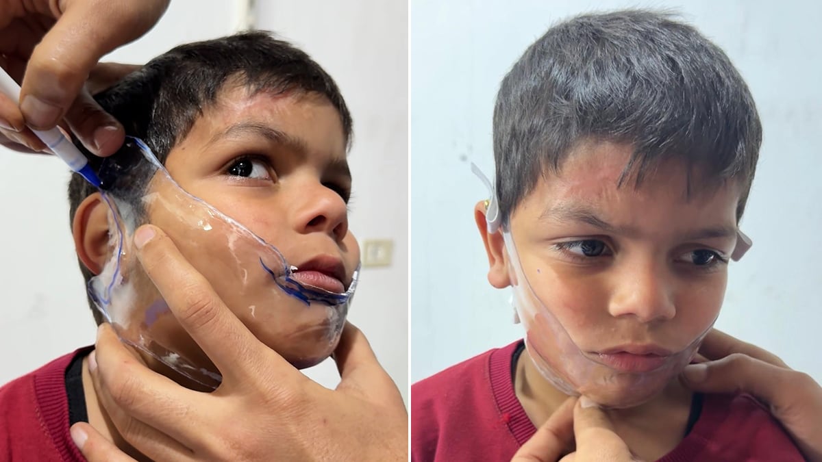 El alivio imposible de los pacientes quemados durante los ataques en Gaza: “No entra nada desde enero. Estamos asfixiados”